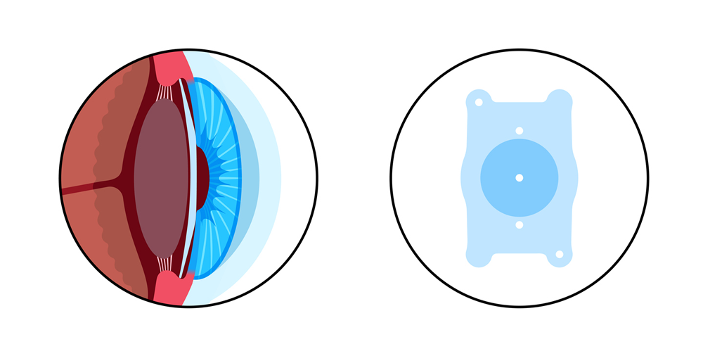 ICL Linse in der schematischen Darstellung im Auge